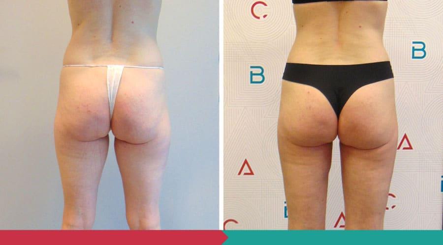 Liposuction ABClinic Praha18