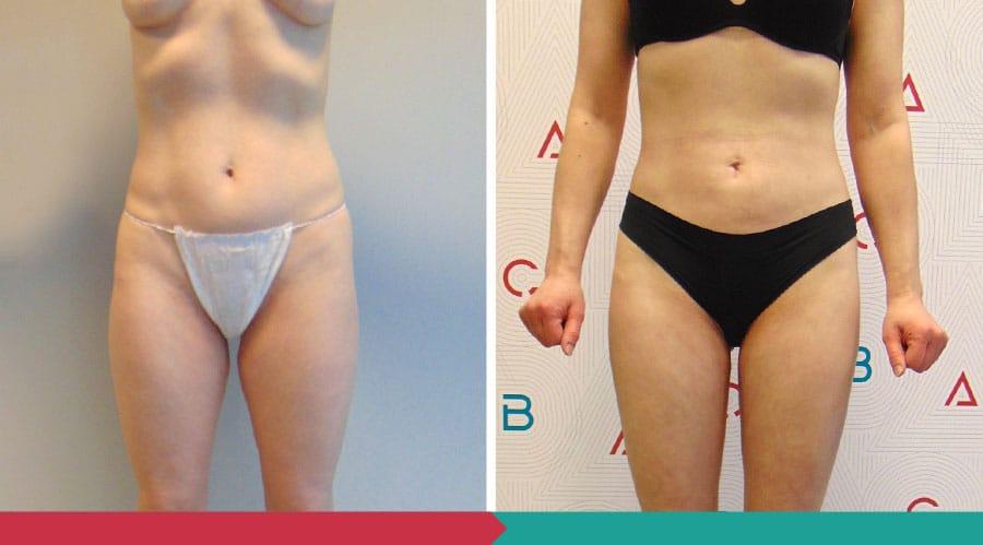Liposuction ABClinic Praha19