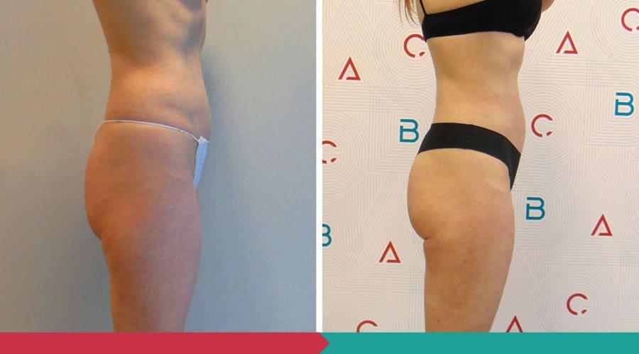 Liposuction ABClinic Praha20