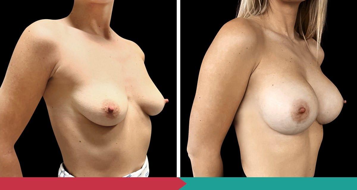 Breast Augmentation ABClinic Praha1