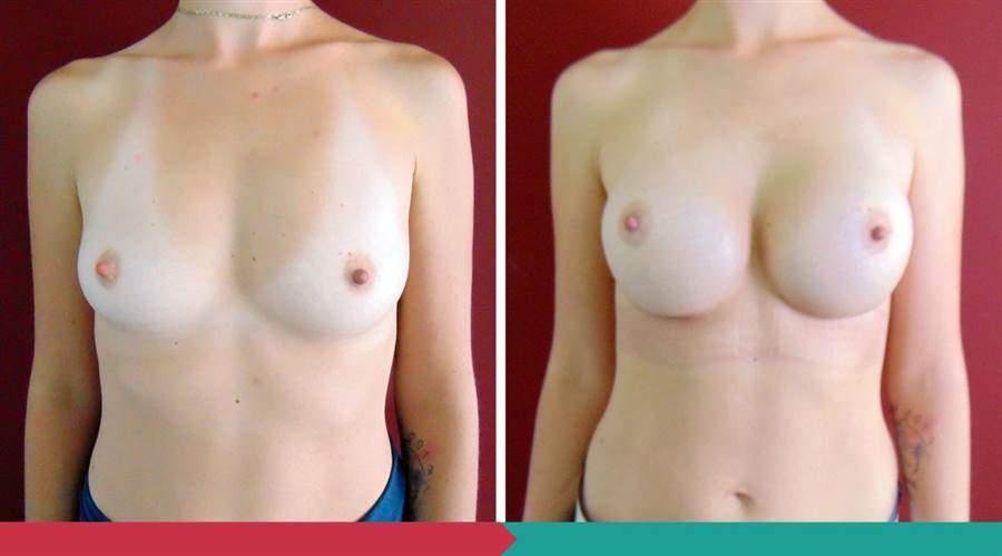 Breast Augmentation ABClinic Praha3