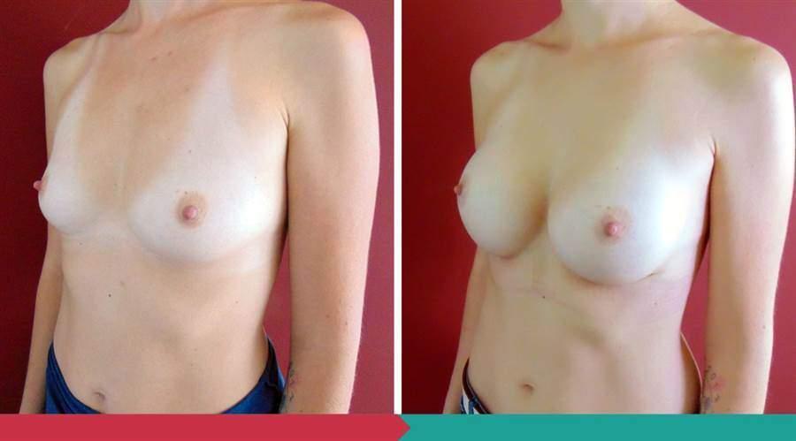 Breast Augmentation ABClinic Praha5