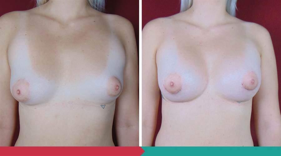 Breast Augmentation ABClinic Praha6