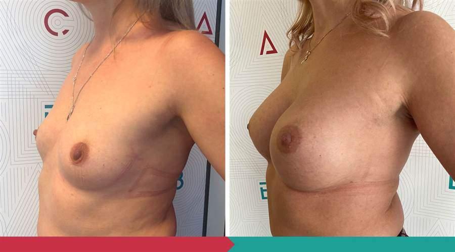 Breast Augmentation ABClinic Praha8