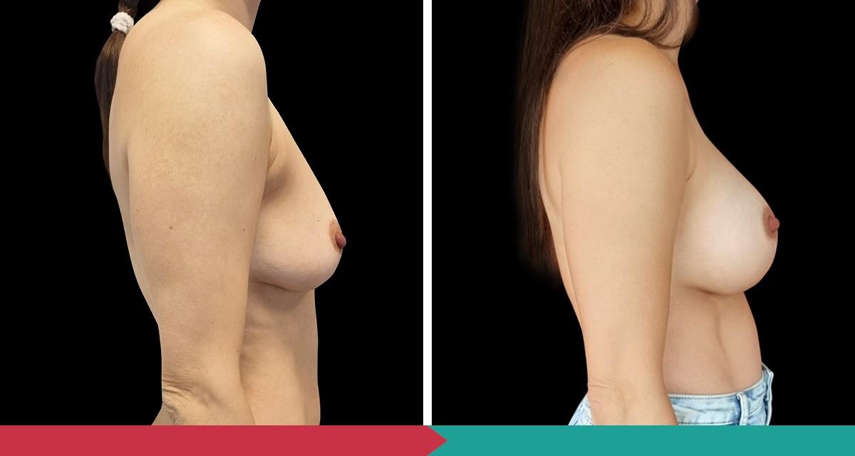 Breast Augmentation ABClinic Praha11