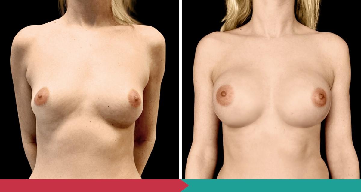 Breast Augmentation ABClinic Praha13