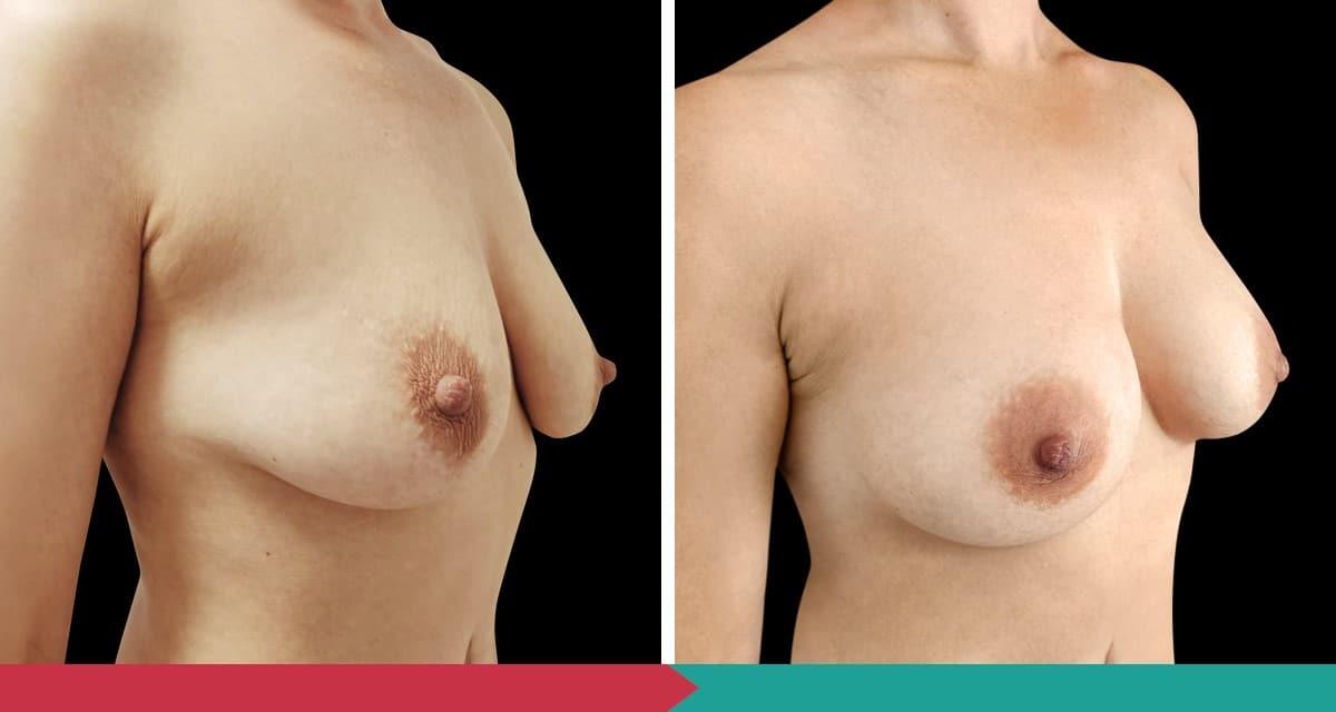 Breast Augmentation ABClinic Praha15