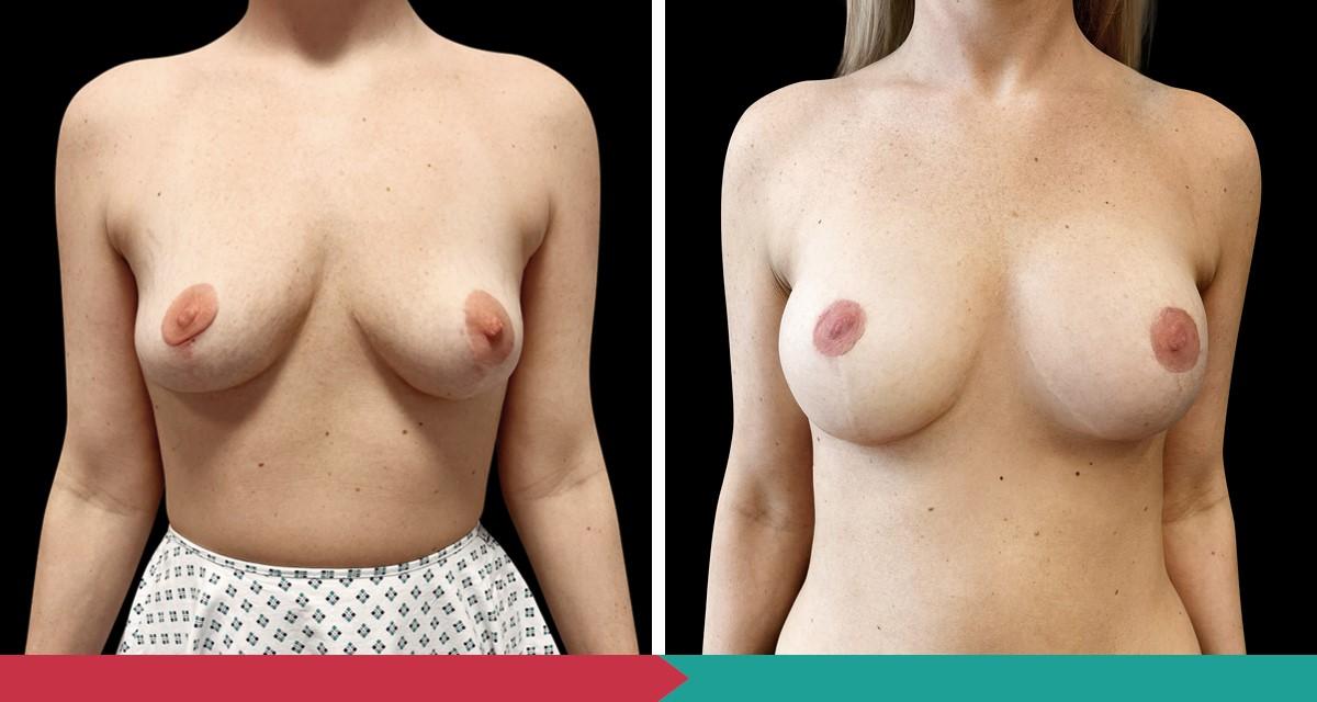 Breast lift ABClinic Praha1