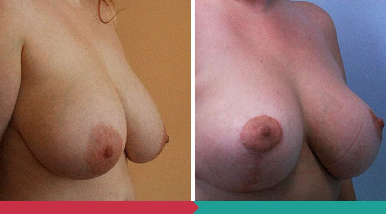 Breast lift ABClinic Praha2