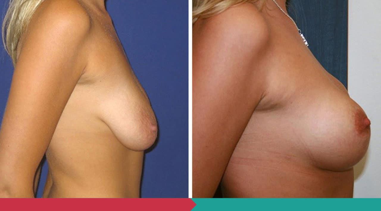 Breast lift ABClinic Praha3