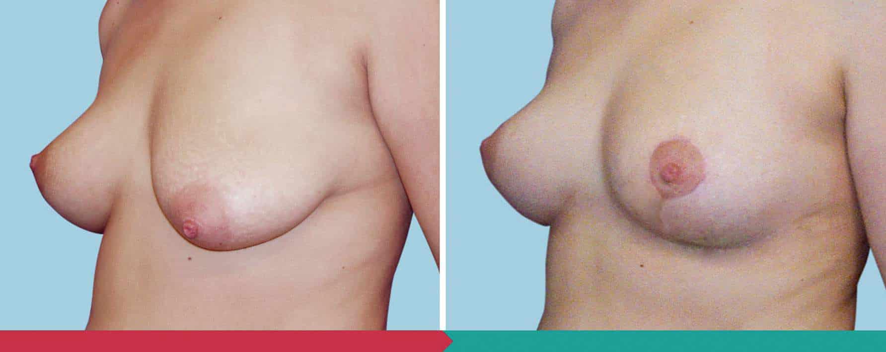 Breast lift ABClinic Praha4
