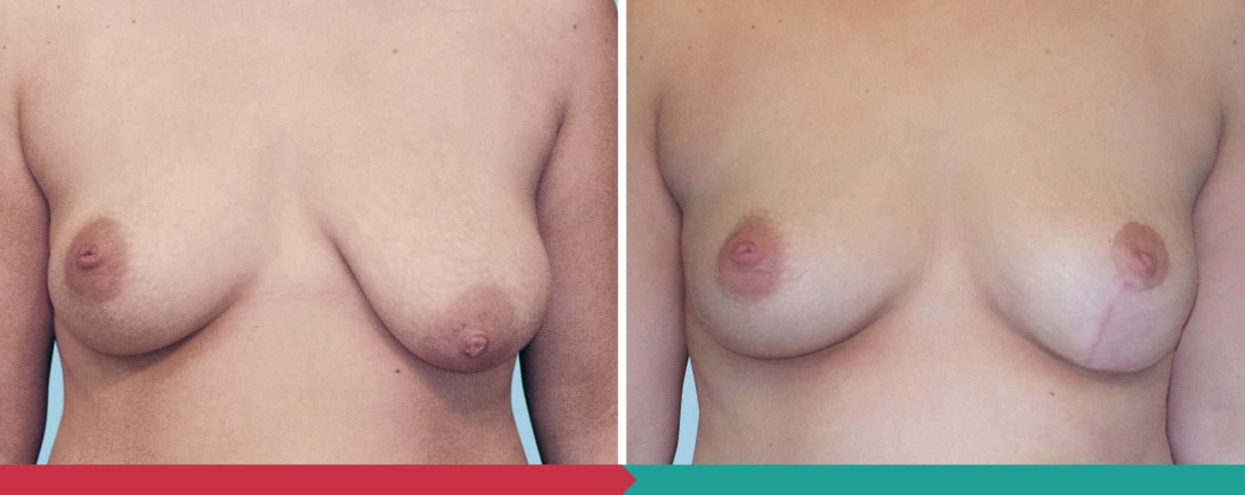 Breast lift ABClinic Praha5
