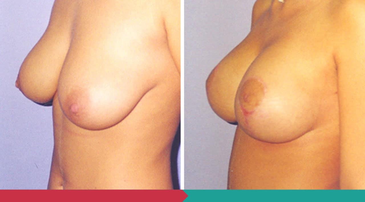 Breast lift ABClinic Praha6