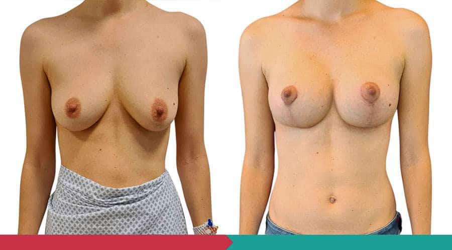 Breast lift ABClinic Praha7