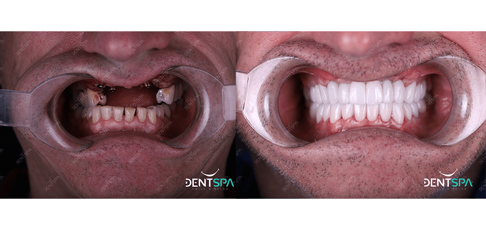 Implants dentspa 1