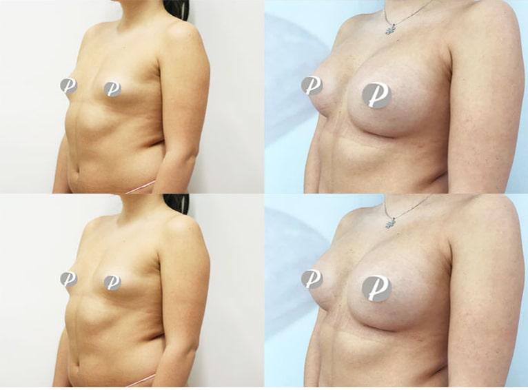 breastaugmentation-4-min