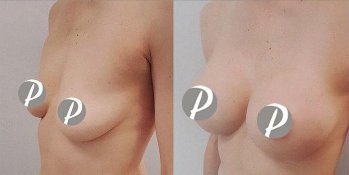 breastaugmentation-5-min