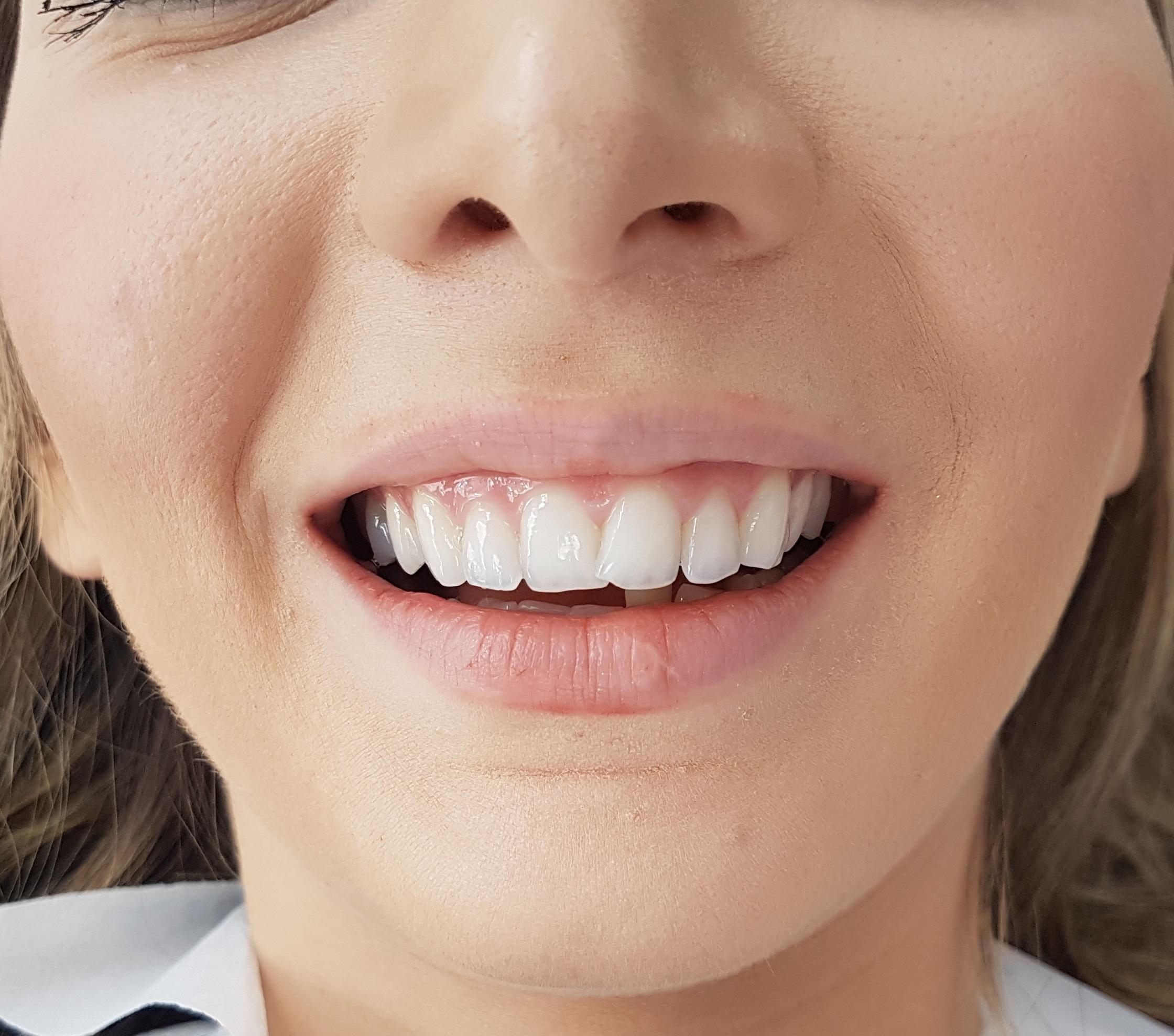 Before Veneers / Avant facettes