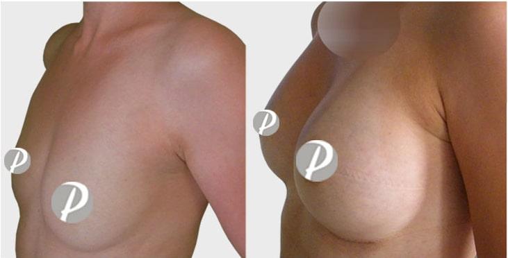 breastaugmentation-6-min
