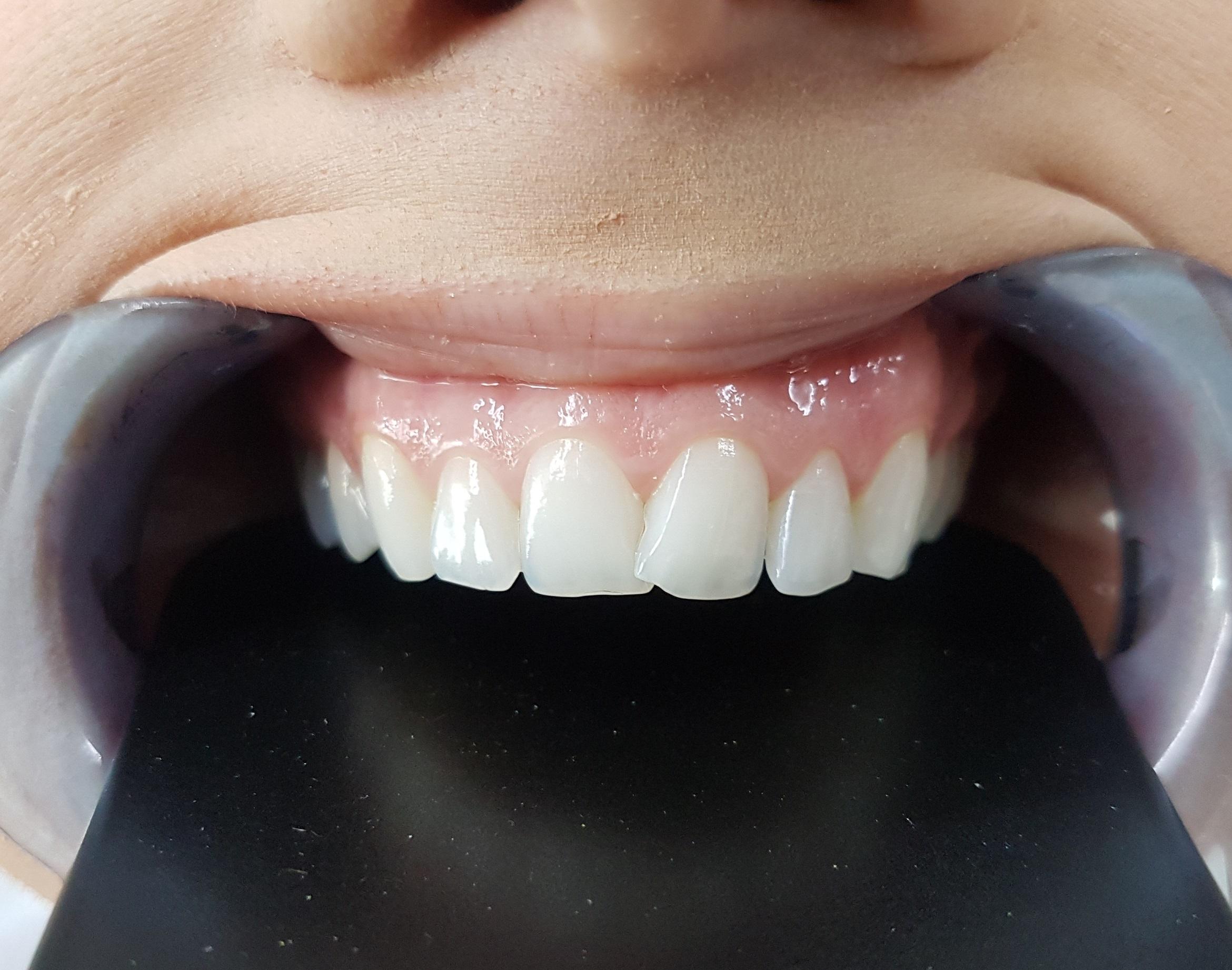 Before Veneers / Avant facettes