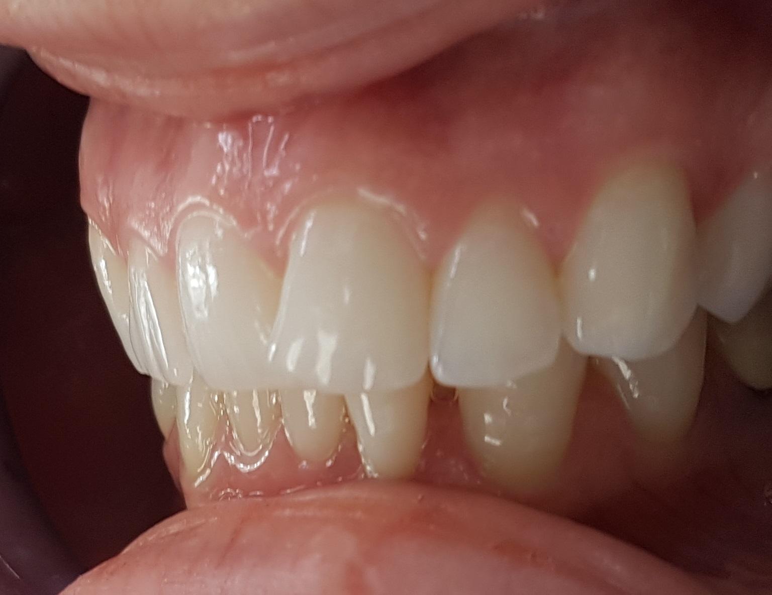 Before Veneers / Avant facettes