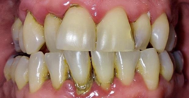 Before Veneers / Avant facettes