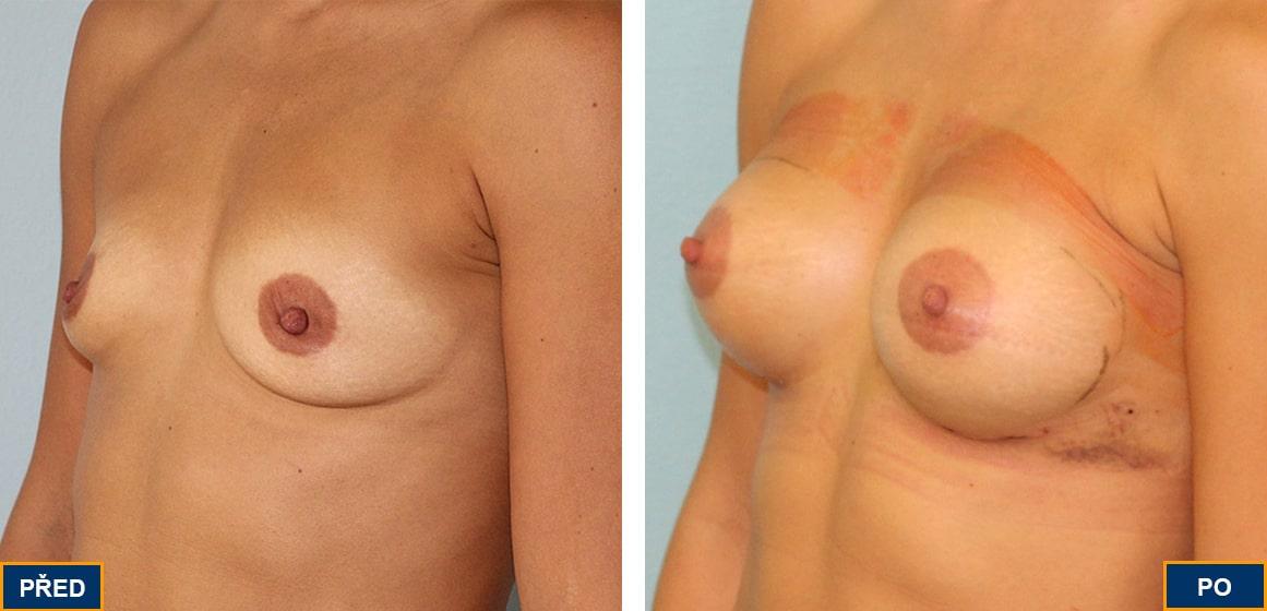 Breast Augmentation by Premier Clinic