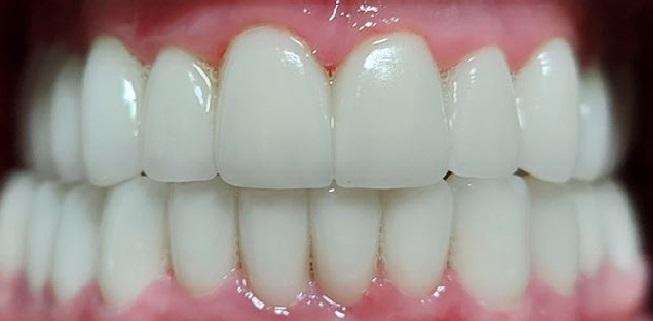 After Veneers / Après facettes