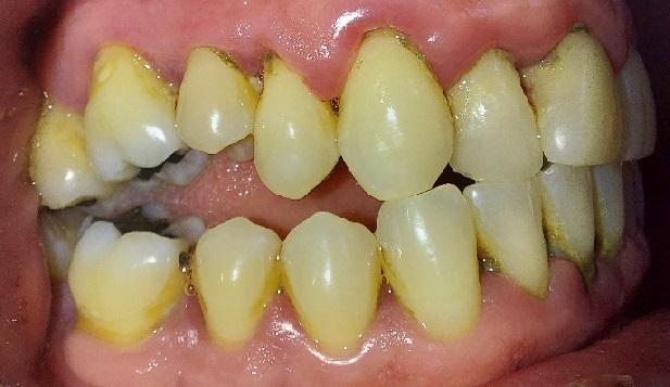 Before Veneers / Avant facettes