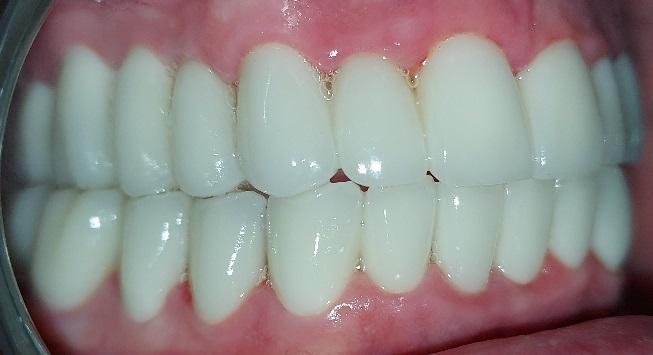 After Veneers / Après facettes