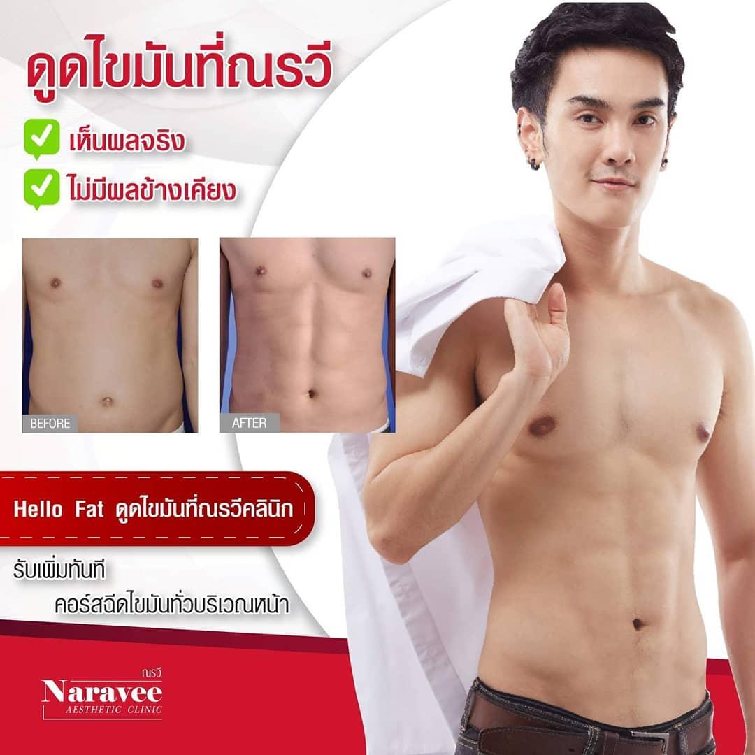 Liposuccion by Dr Ron Naravee Clinic