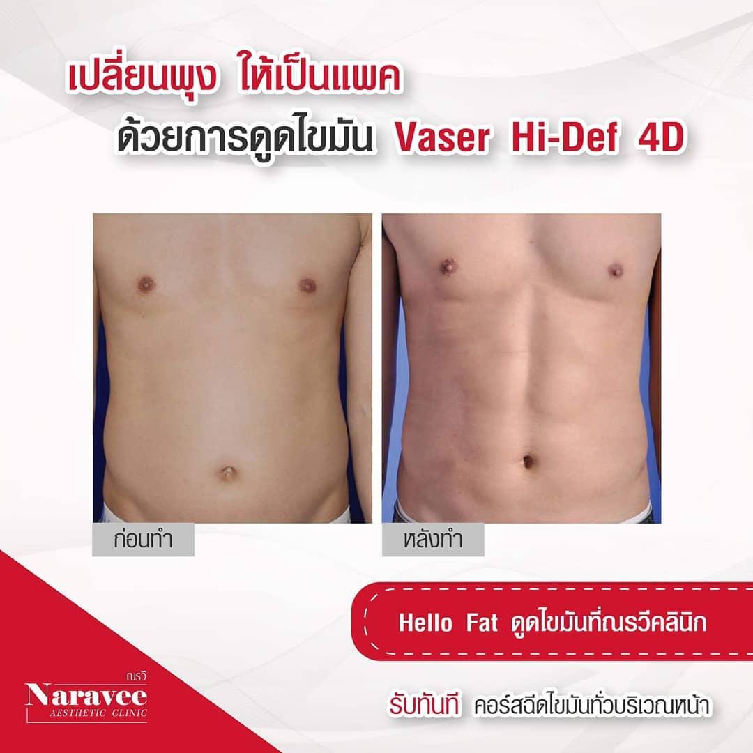 Liposuccion by Dr Ron Naravee Clinic
