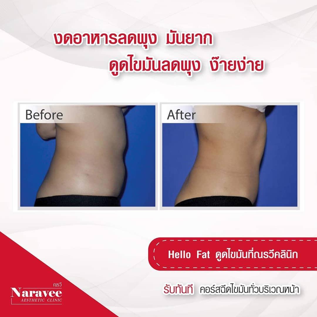 Liposuccion by Dr Ron Naravee Clinic