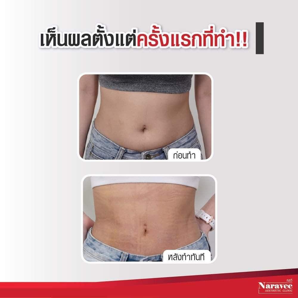 Liposuccion by Dr Ron Naravee Clinic