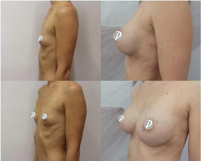 Breast Augmentation by Premier Clinic