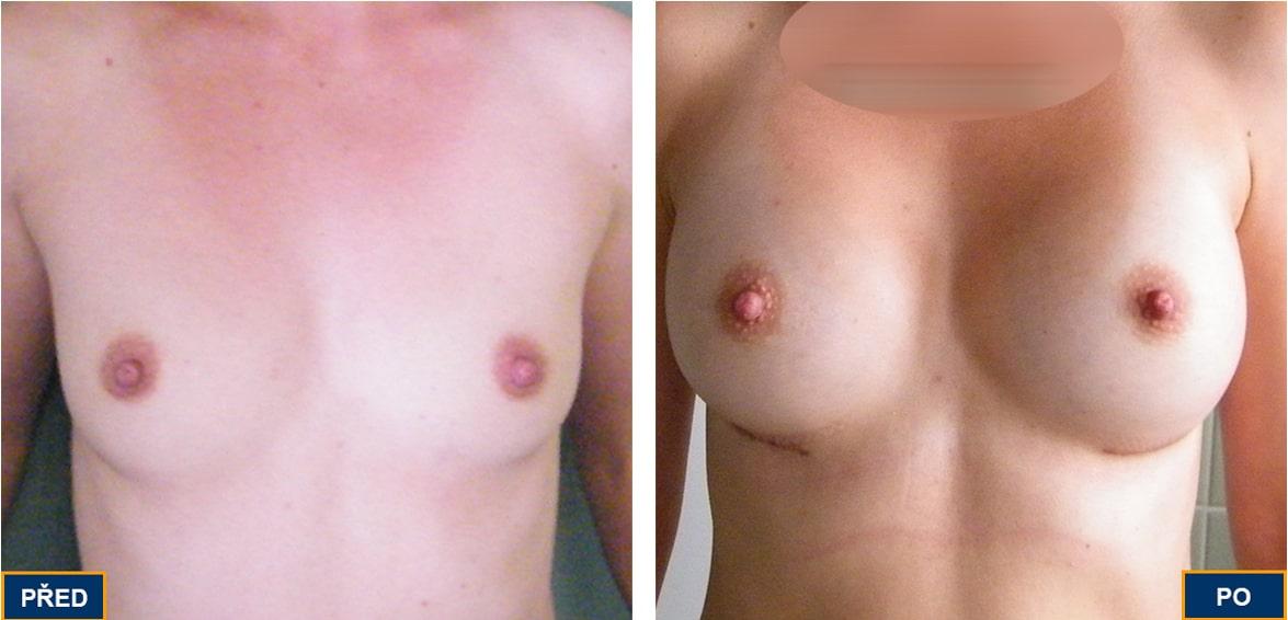 Breast Augmentation by Premier Clinic