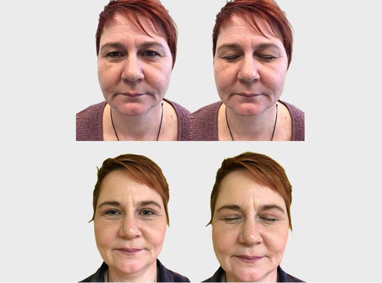 liftingvisage-1 (1)-min