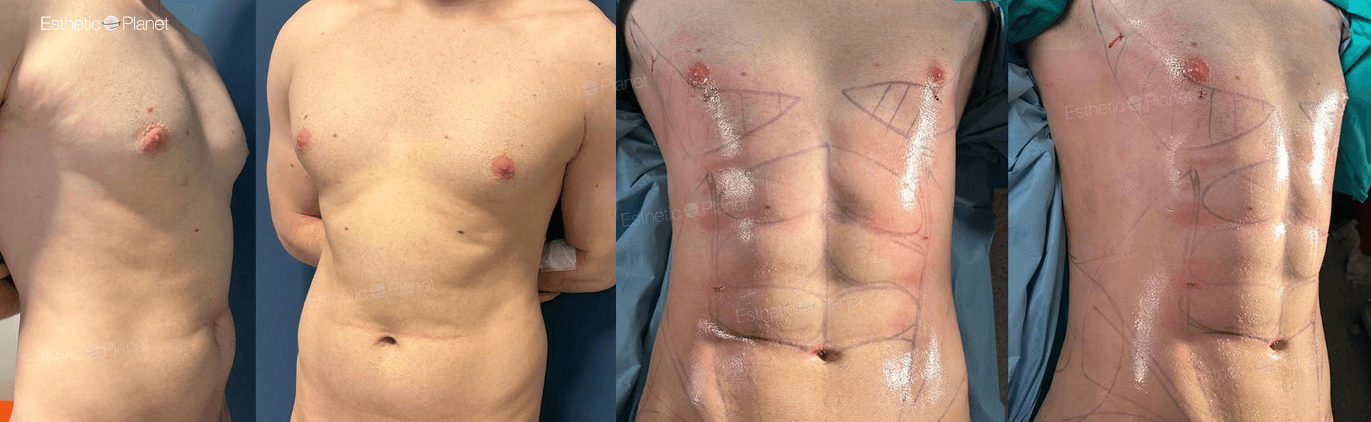 DR Ergin Er LIPO HD