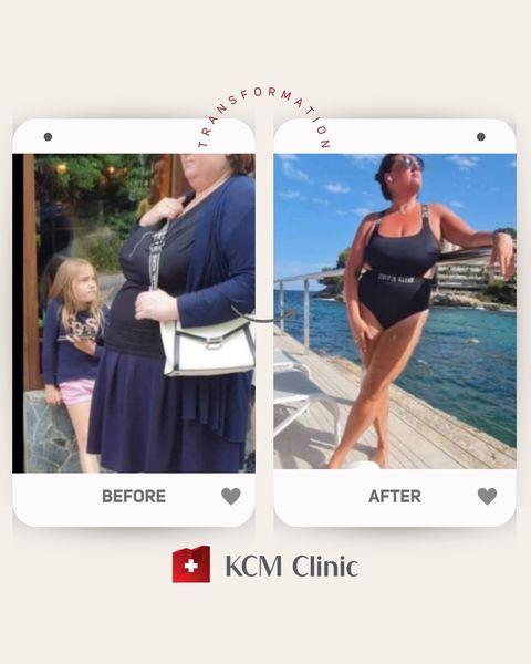 Weightloss at KCM clinic