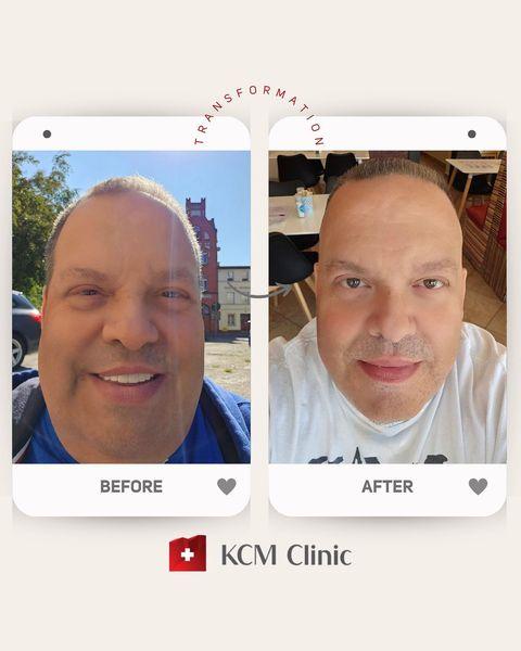 Weightloss at KCM clinic