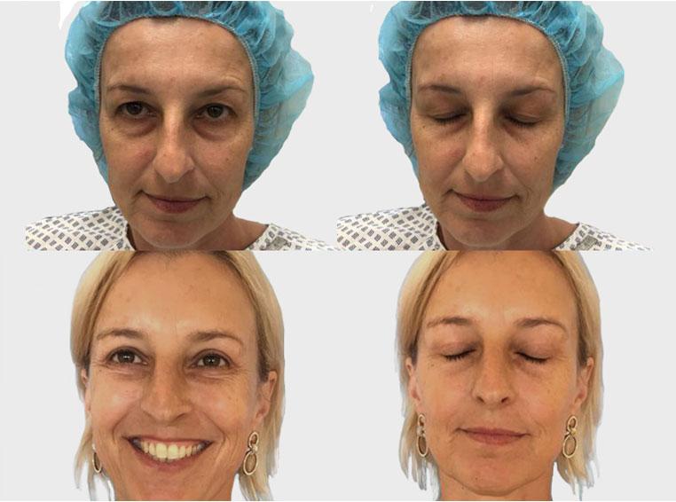 blepharoplasty by Premier Clinic
