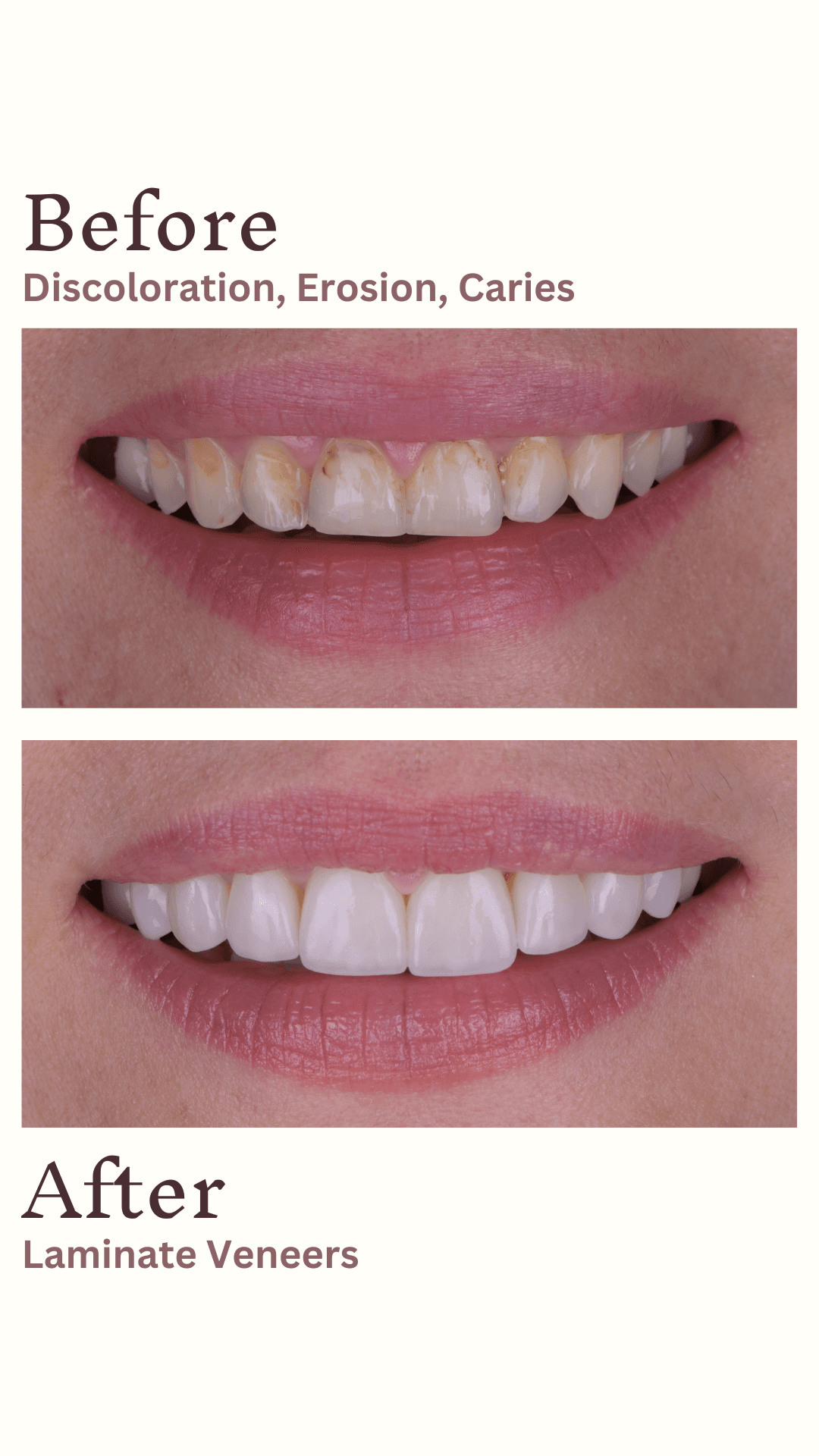 4 D.T Veneers