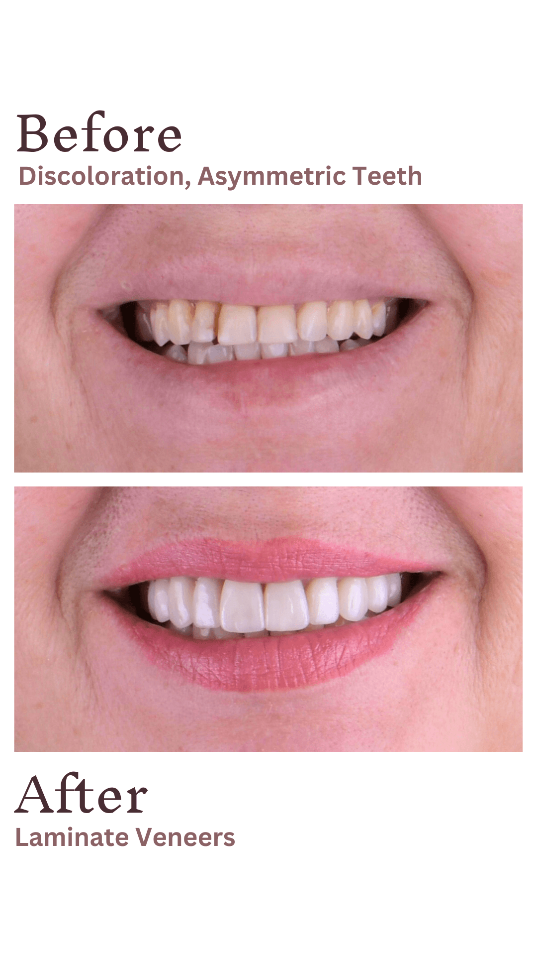 S.G Veneers