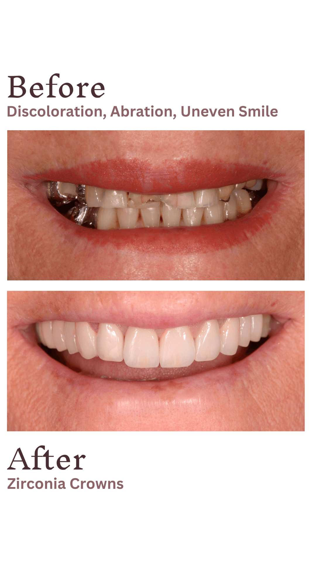 A.K. Zirconia Crowns