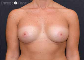 Augmentation-mammaire-budapest-Apres-4-min