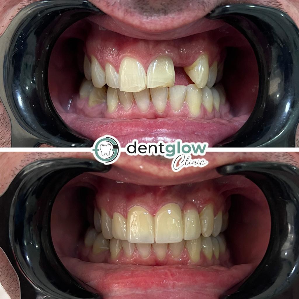 facette composites : venners bonding