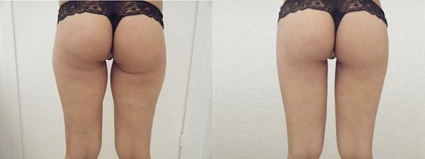 lifting-des-cuisses-avant-apres