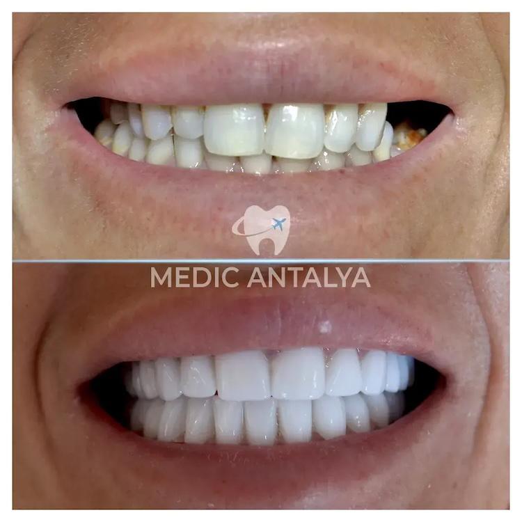 Medic antalya - Dental results5