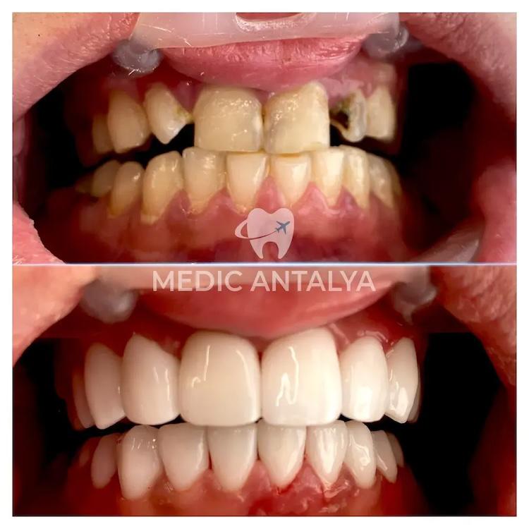 Medic antalya - Dental results10