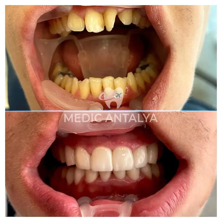 Medic antalya - Dental results11